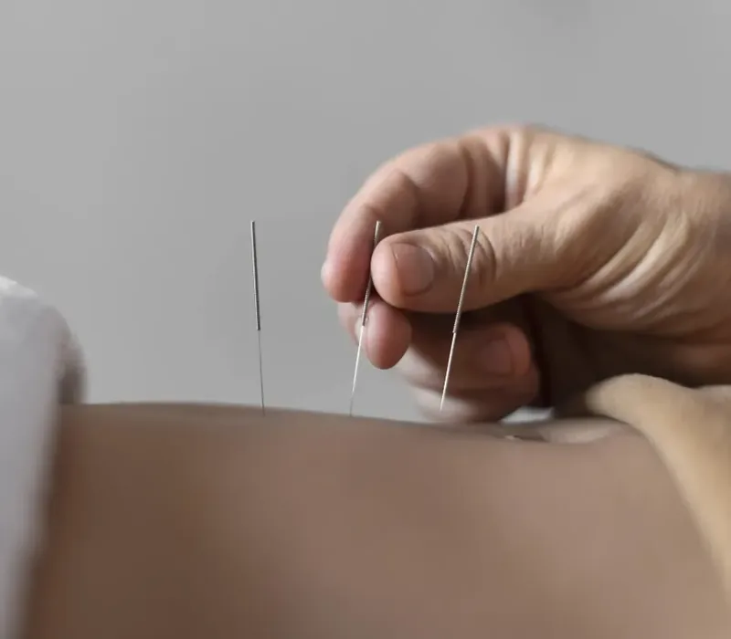 Close-up of a dry needling trigger-point treatment