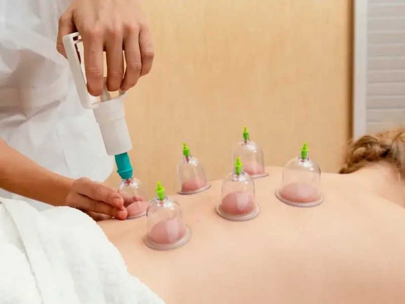 Cupping applied to a patient's back by a Doctor of Physical Therapy