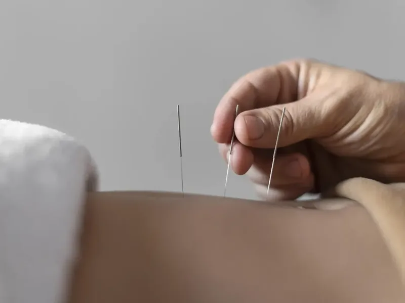 Doctor of Physical Therapy performing dry needling on a patient's shoulder