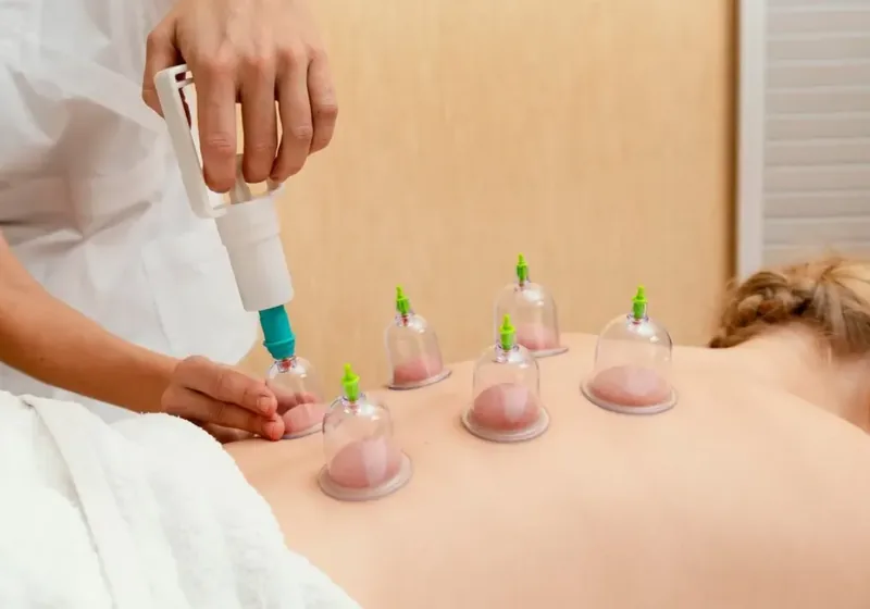 Close-up of cupping therapy applied to a patient&rsquo;s back