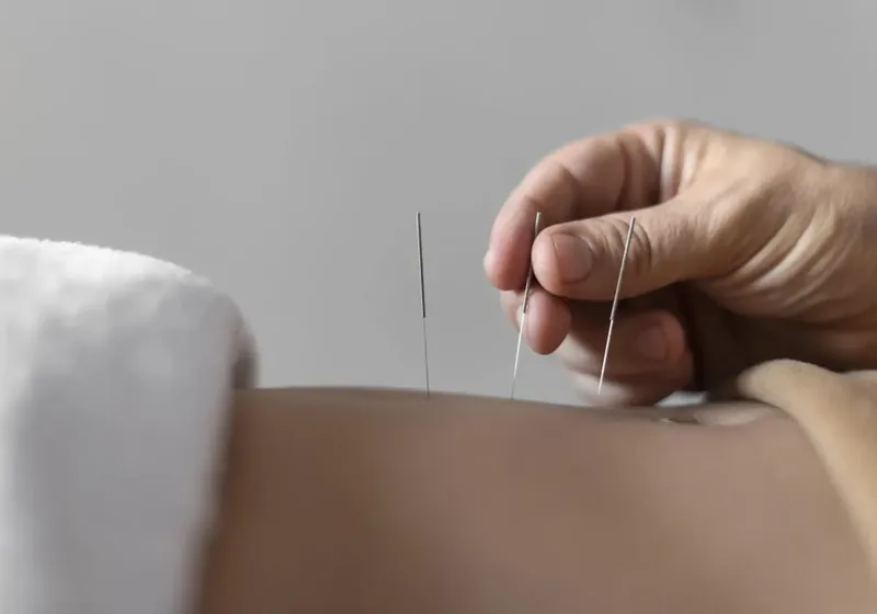 Close-up of a dry needling trigger-point treatment