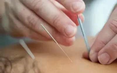 Understanding Dry Needling vs Botox for Headache Relief: Effectiveness, Costs, and Side Effects